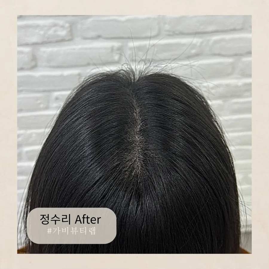 가비뷰티랩 정수리 SMP · 실제 시술 후