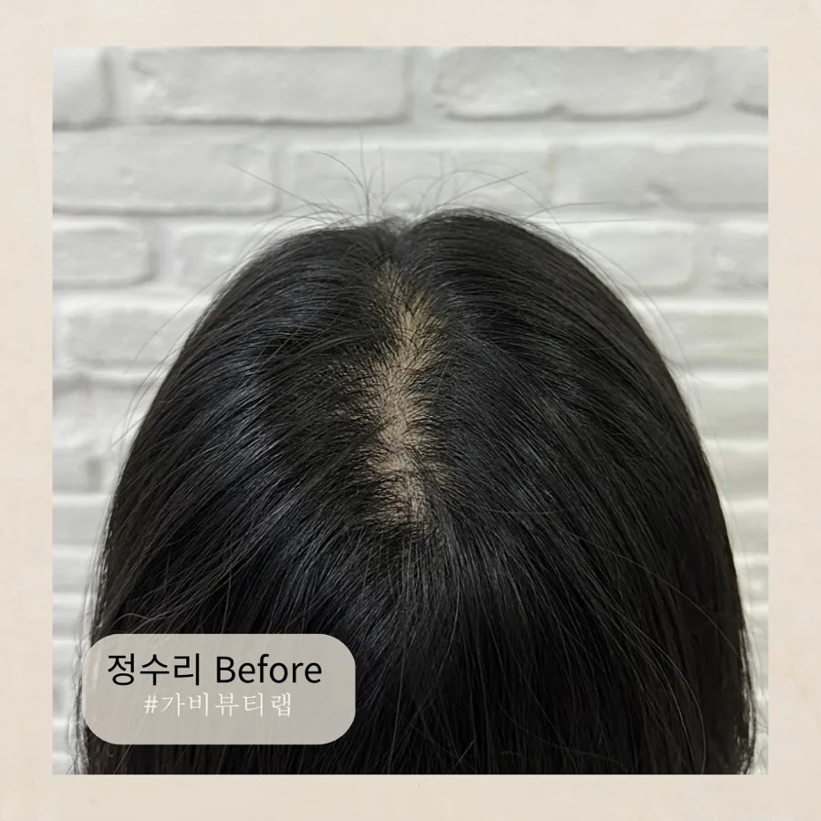 가비뷰티랩 정수리 시술 전