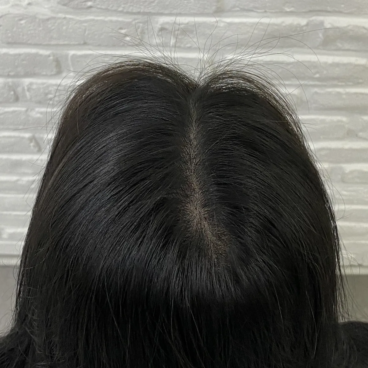 가비뷰티랩 가르마 SMP · 실제 시술 후